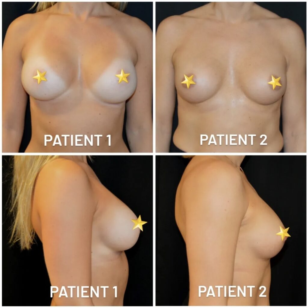 Zväčšenie Pŕs Implantátmi (augmentácia)